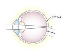 Digital illustration of an eyeball with farsightedness