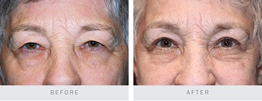 Before and After: Bilateral Upper Eyelid Blepharoplasty, Browplasty